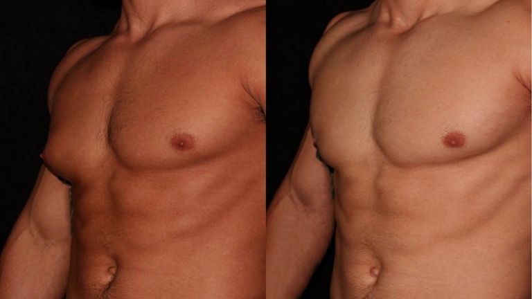 Healing and Progress: Managing Recovery After Gynecomastia Surgery